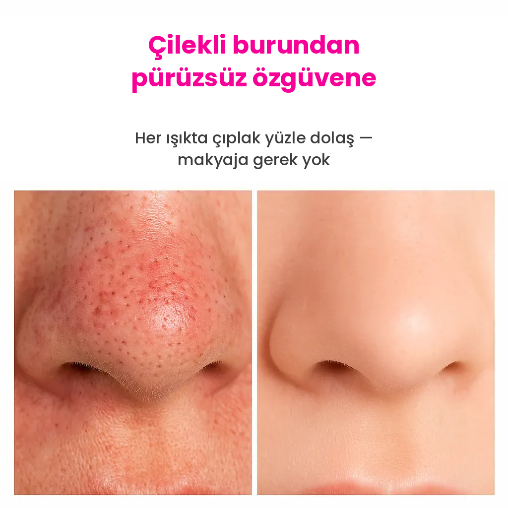 Pore Vio™ — Elektrikli Gözenek Temizleme Cihazı